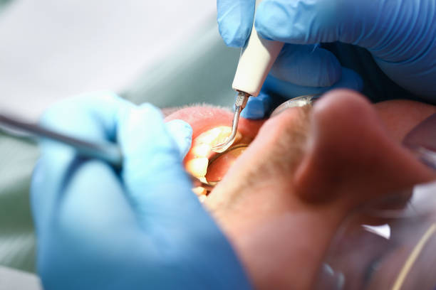 Best Broken or Cracked Tooth Emergency Dentist in Rocklin, CA